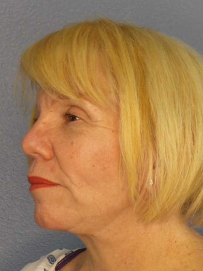 Facelift Before & After Patient #7573