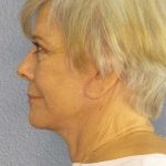 Facelift Before & After Patient #11683