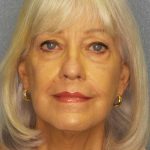 Facelift Before & After Patient #11892