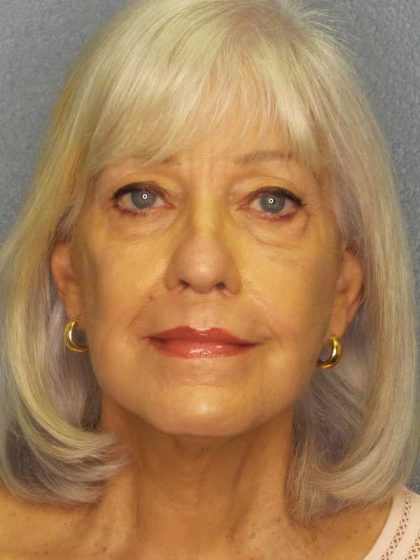 Facelift Before & After Patient #11892