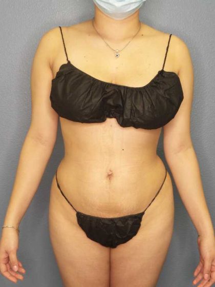 Brazilian Butt Lift Before & After Patient #11305