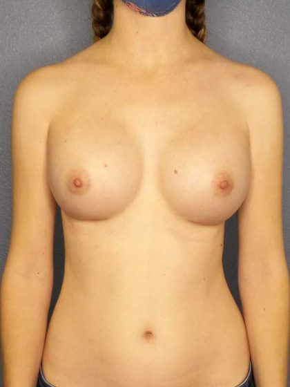 Breast Augmentation Before & After Patient #11498