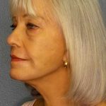 Facelift Before & After Patient #11892
