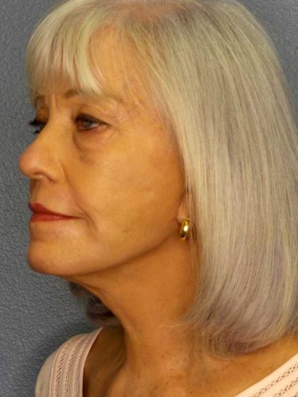 Facelift Before & After Patient #11892