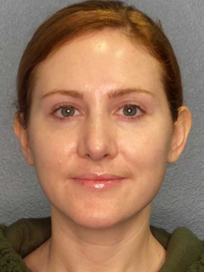Rhinoplasty Before & After Patient #11013