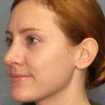 Rhinoplasty Before & After Patient #11013