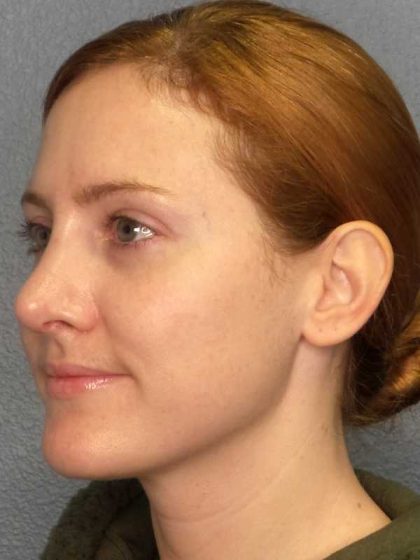 Rhinoplasty Before & After Patient #11013