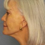 Facelift Before & After Patient #11892