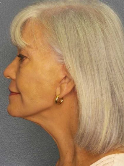 Facelift Before & After Patient #11892