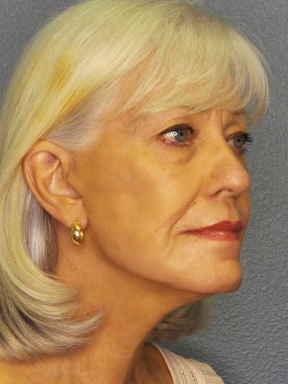 Facelift Before & After Patient #11892