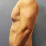 Male Liposuction Before & After Patient #8201