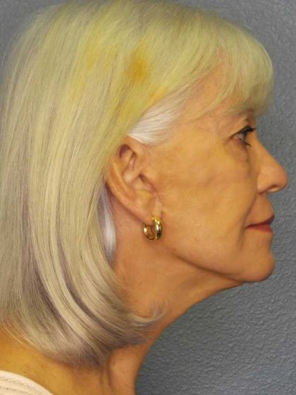 Facelift Before & After Patient #11892