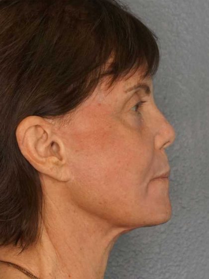 Resurfacing Before & After Patient #12297