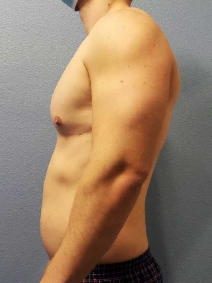 Male Liposuction Before & After Patient #8201