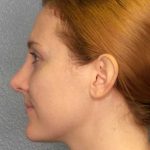 Rhinoplasty Before & After Patient #11013