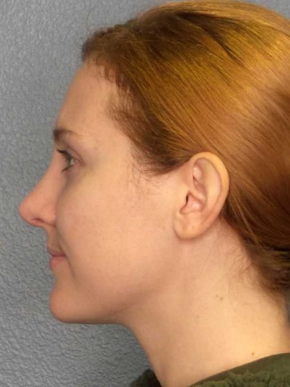 Rhinoplasty Before & After Patient #11013