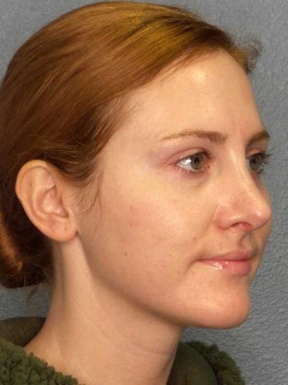 Rhinoplasty Before & After Patient #11013