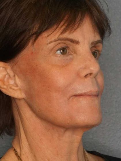 Resurfacing Before & After Patient #12297