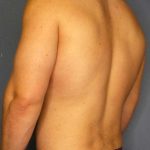 Male Liposuction Before & After Patient #8201