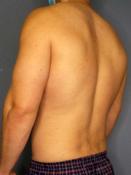 Male Liposuction Before & After Patient #8201