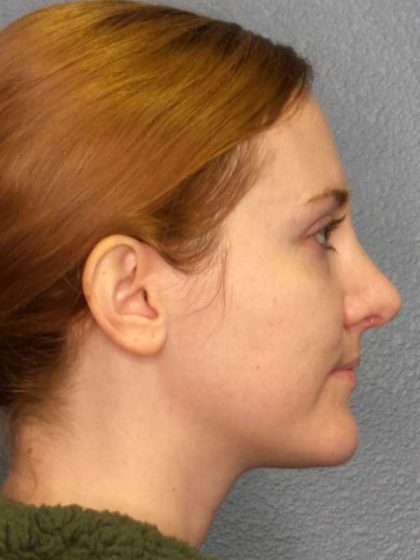 Rhinoplasty Before & After Patient #11013