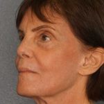 Resurfacing Before & After Patient #12297