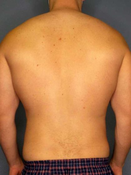 Male Liposuction Before & After Patient #8201