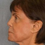 Resurfacing Before & After Patient #12297