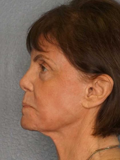 Resurfacing Before & After Patient #12297