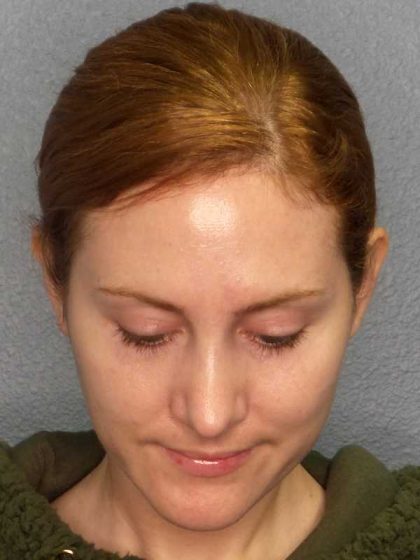 Rhinoplasty Before & After Patient #11013