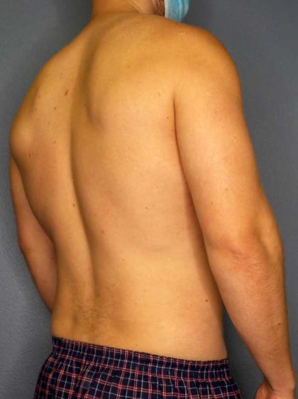 Male Liposuction Before & After Patient #8201