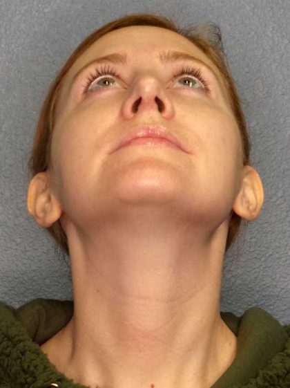 Rhinoplasty Before & After Patient #11013
