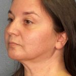 Liposuction of the Neck Before & After Patient #12148