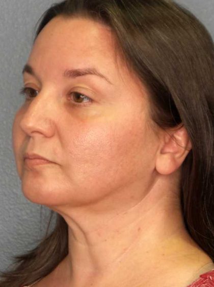 Liposuction of the Neck Before & After Patient #12148