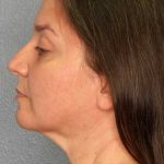 Liposuction of the Neck Before & After Patient #12148