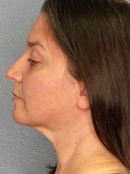 Liposuction of the Neck Before & After Patient #12148