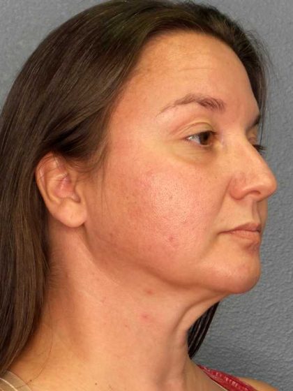 Liposuction of the Neck Before & After Patient #12148