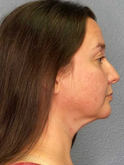 Liposuction of the Neck Before & After Patient #12148