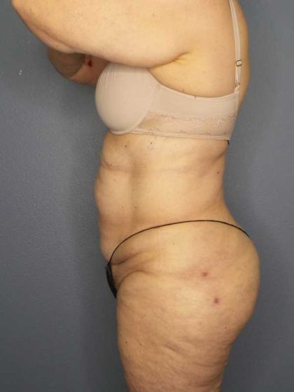 High BMI (Larger Patients) Surgery Before & After Patient #10444