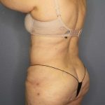 High BMI (Larger Patients) Surgery Before & After Patient #10444