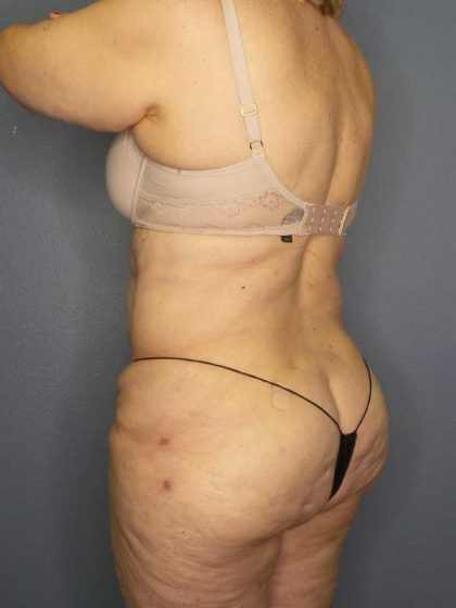 High BMI (Larger Patients) Surgery Before & After Patient #10444