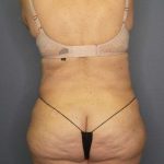 High BMI (Larger Patients) Surgery Before & After Patient #10444