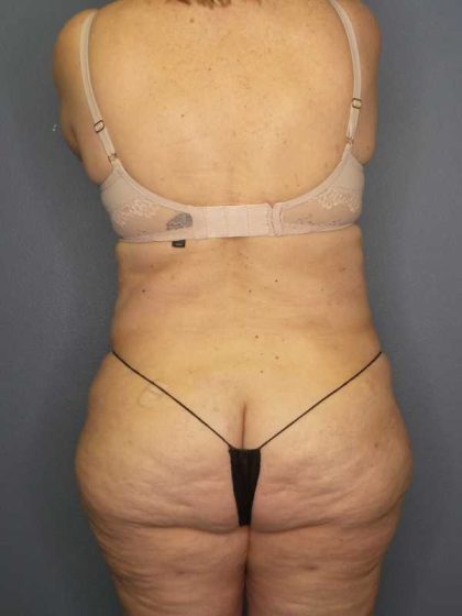High BMI (Larger Patients) Surgery Before & After Patient #10444