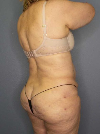 High BMI (Larger Patients) Surgery Before & After Patient #10444