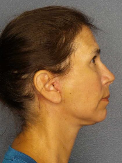 Facelift Before & After Patient #7557