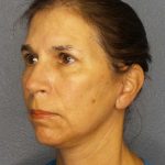 Facelift Before & After Patient #7557