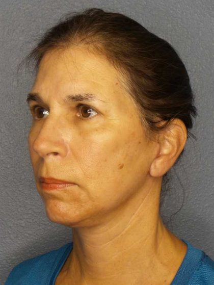 Facelift Before & After Patient #7557