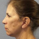 Facelift Before & After Patient #7557