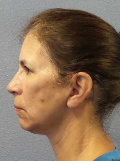 Facelift Before & After Patient #7557