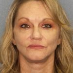 Facelift Before & After Patient #11903
